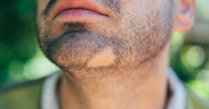 <strong>Are You Facing Bald Patches? It’s Time You Start a Hair Treatment!</strong>