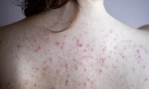 Products that Help Get Rid of Back Acne