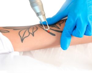 Can Tattoos Be Removed?