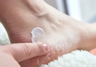 How Does Heel Balm Treat Cracked Heels?